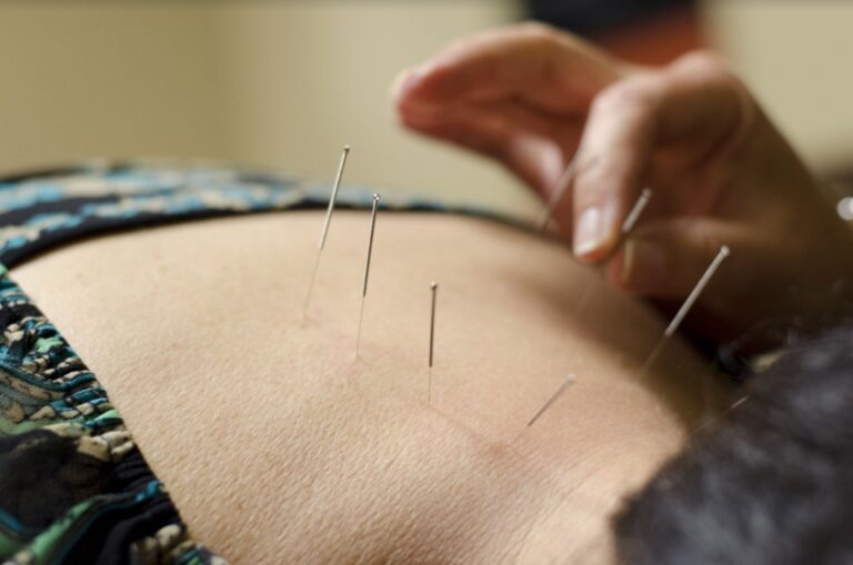 acupuncture 1024x678 1 768x509